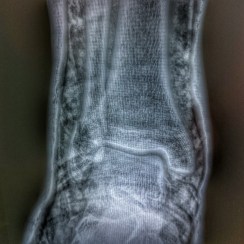Primersauxilis-Fractures-consellfarmaceutic